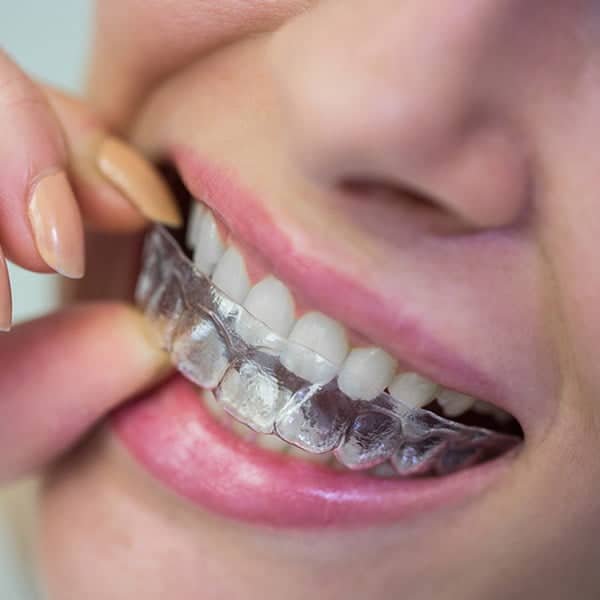 CHAS 蓝卡牙科福利